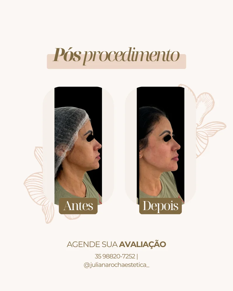 Resultado bioestimulador de colágeno antes e depois Varginha MG — firmeza e viço