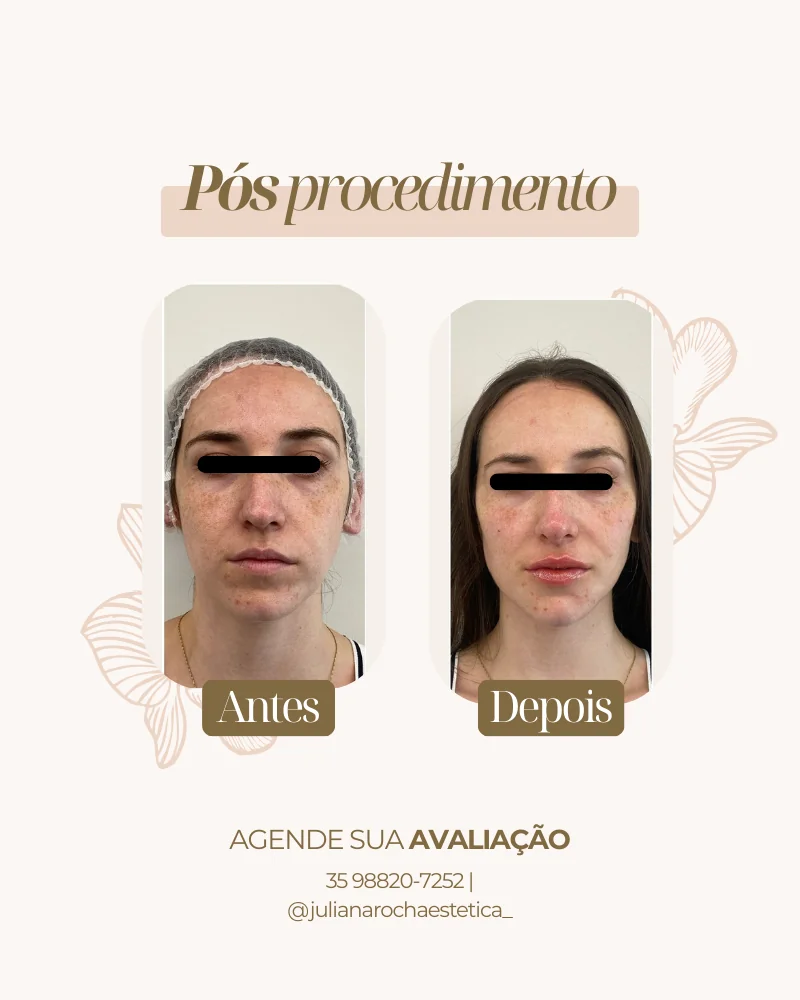 Resultado real — Harmonização Facial em Varginha MG