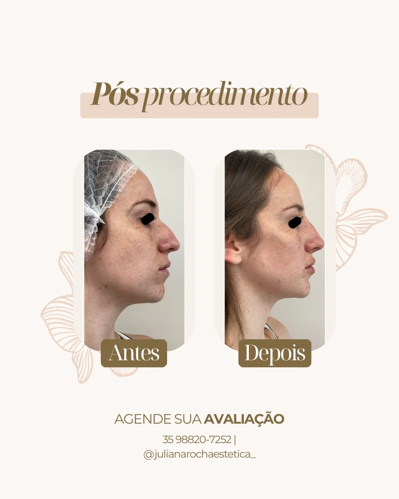 Resultado real — Harmonização Facial em Varginha MG