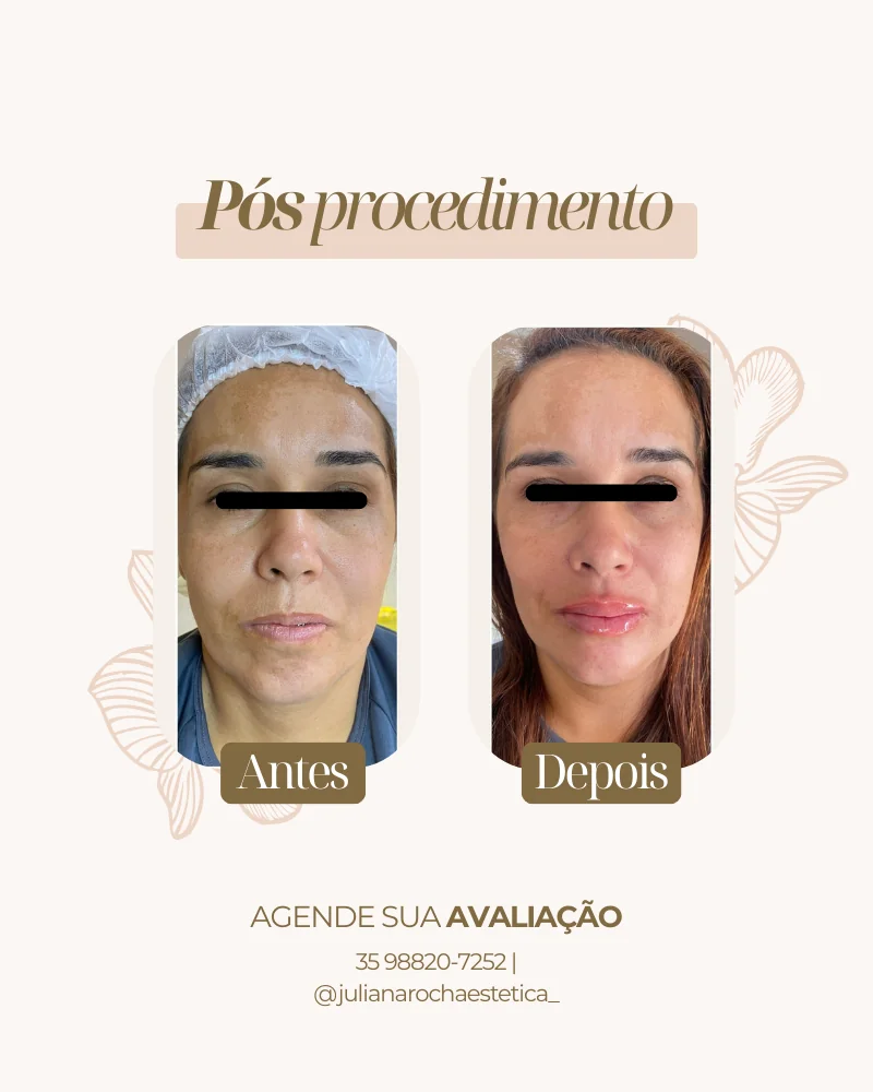 Resultado real — Harmonização Facial em Varginha MG