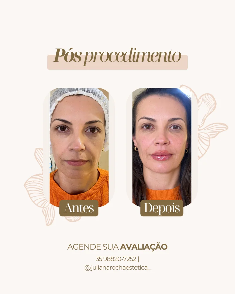 Resultado real — Harmonização Facial em Varginha MG