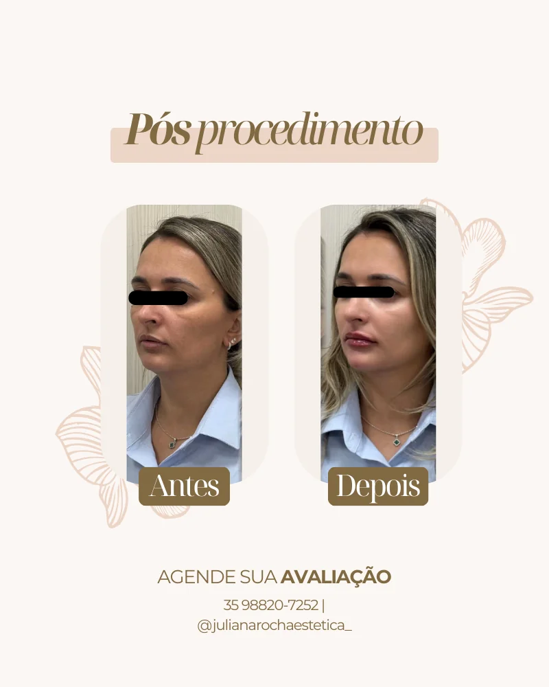 Resultado real — Harmonização Facial em Varginha MG