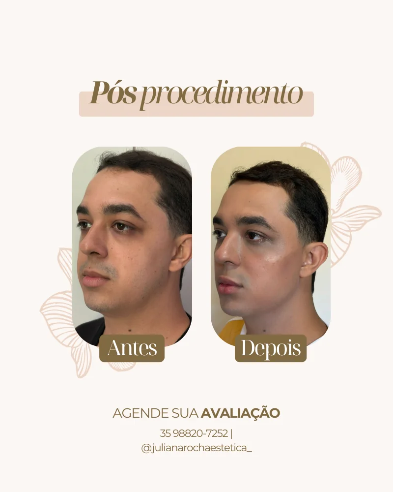 Resultado real — Harmonização Facial em Varginha MG