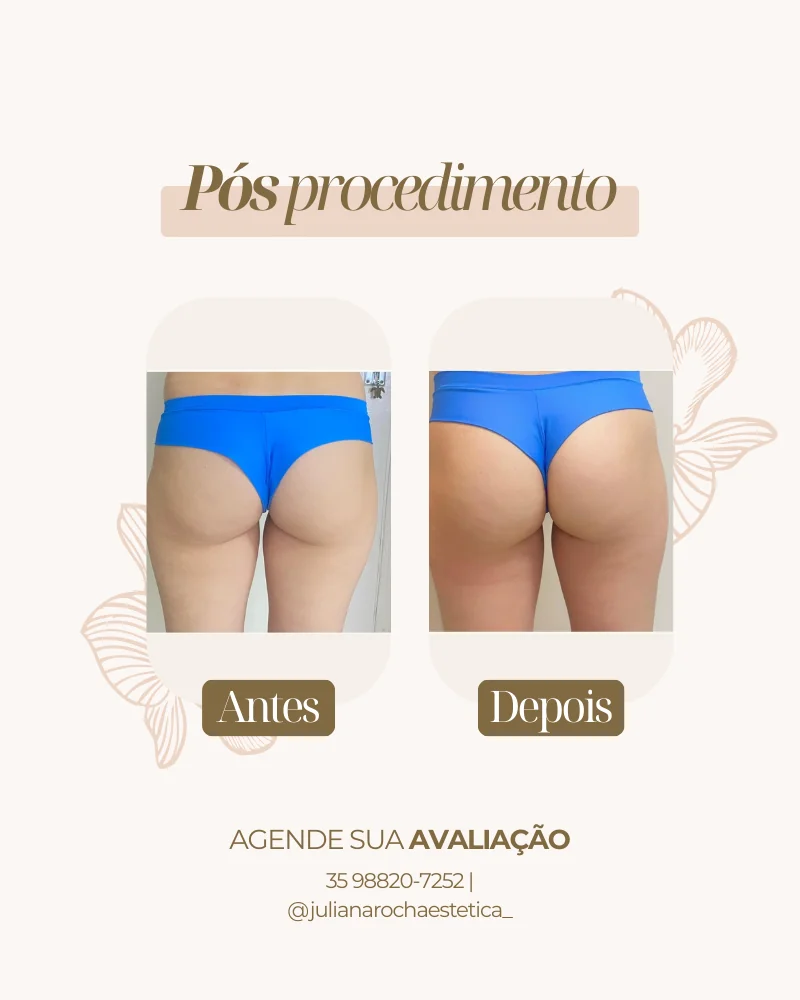 Resultado harmonização glútea antes e depois Varginha MG — clínica estética