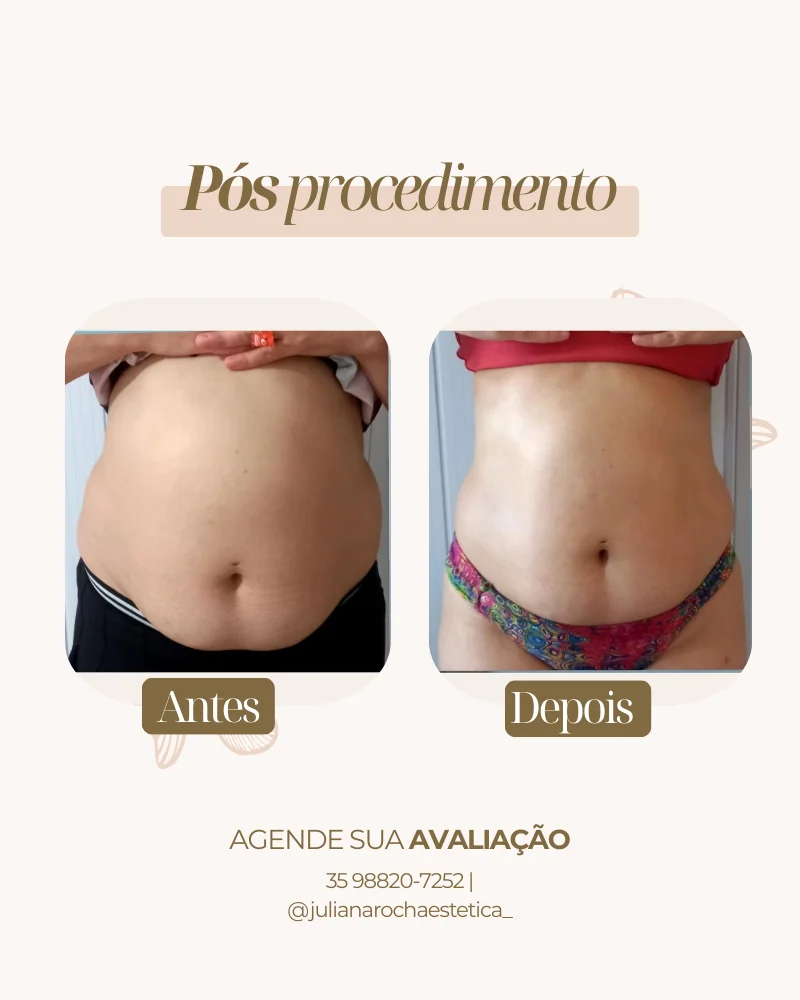 Resultado Harmony Shape modelagem corporal antes e depois em Varginha MG