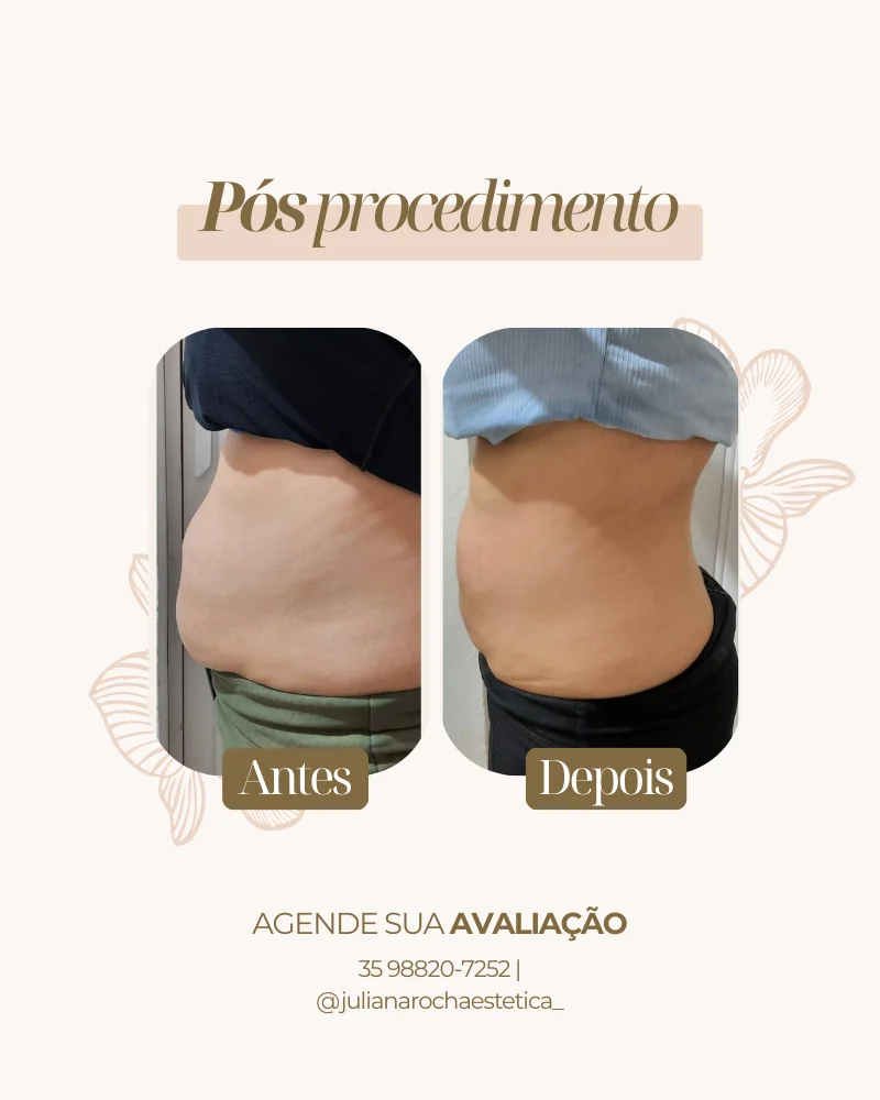 Resultado real — Harmony Shape em Varginha MG