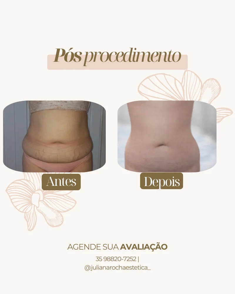 Resultado real — Harmony Shape em Varginha MG