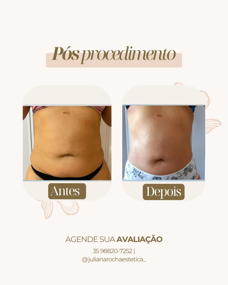 Resultado real — Harmony Shape em Varginha MG