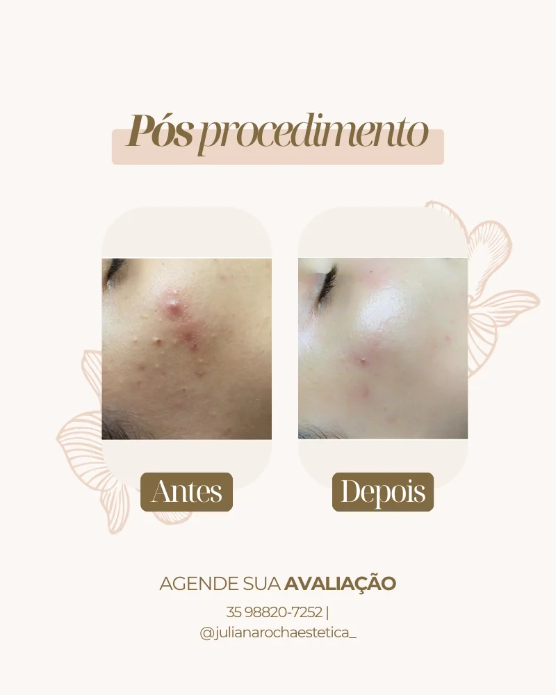 Resultado real — Limpeza de Pele em Varginha MG