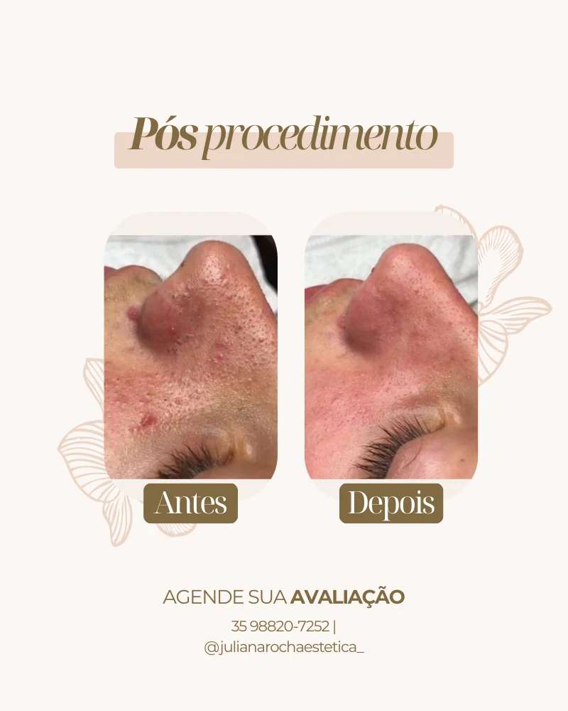 Resultado real — Limpeza de Pele em Varginha MG