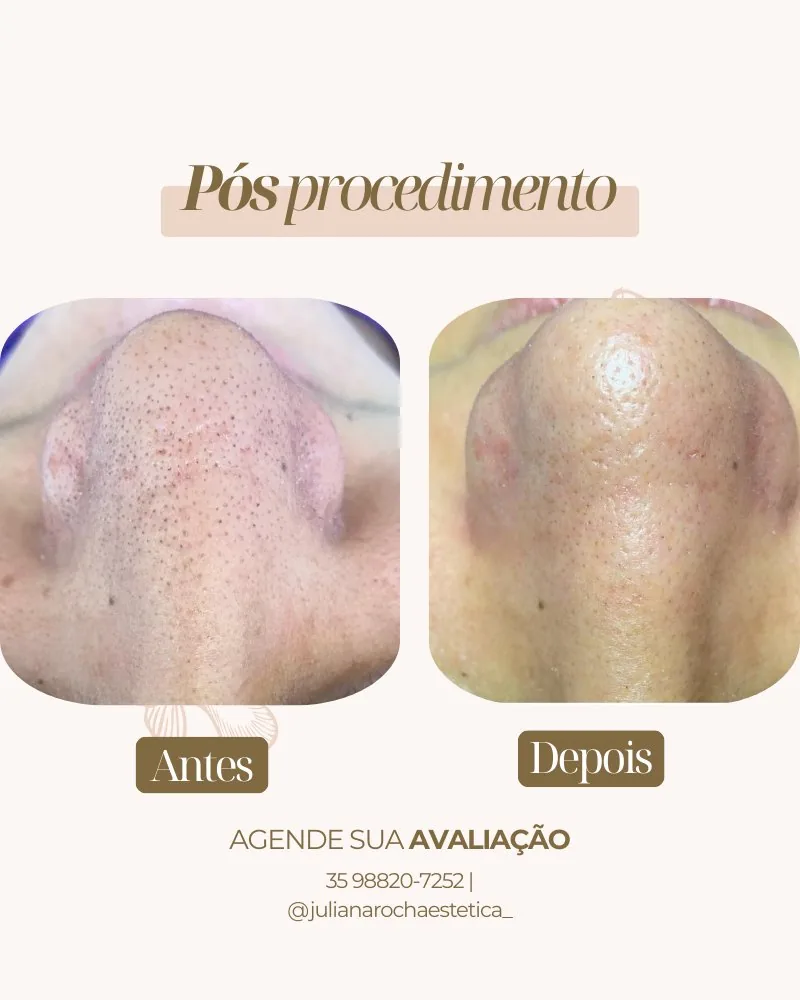 Resultado limpeza de pele desobstrução de poros antes e depois Varginha MG