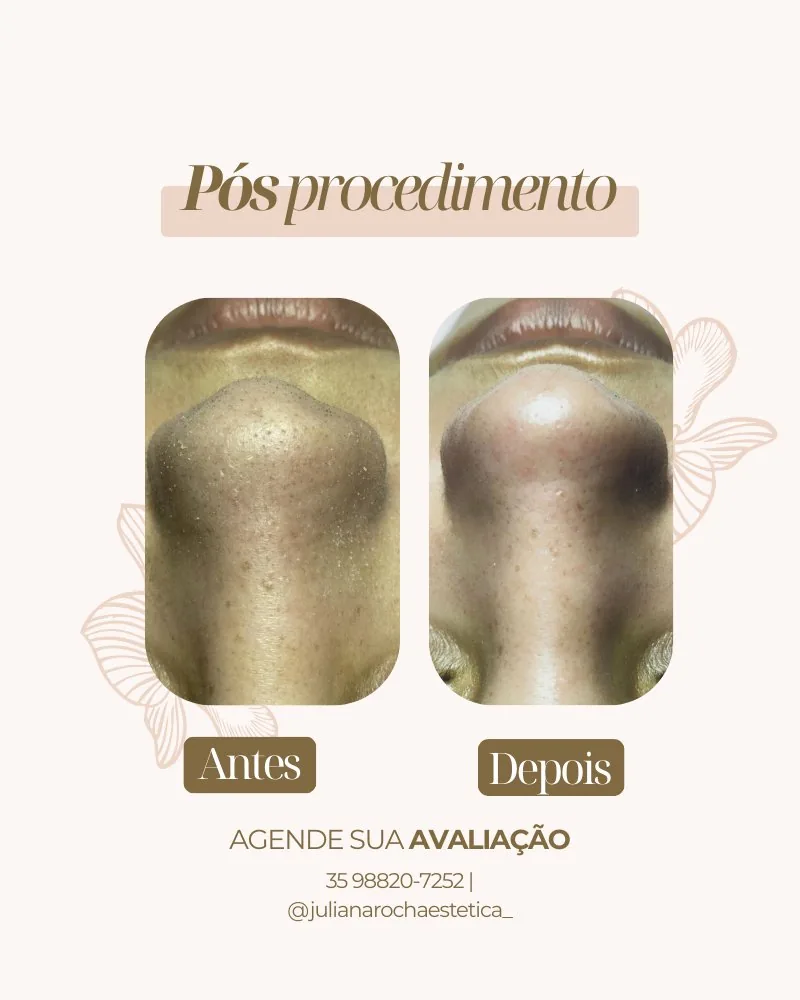 Resultado limpeza de pele poros nasais antes e depois Varginha MG — desobstrução e limpeza profunda