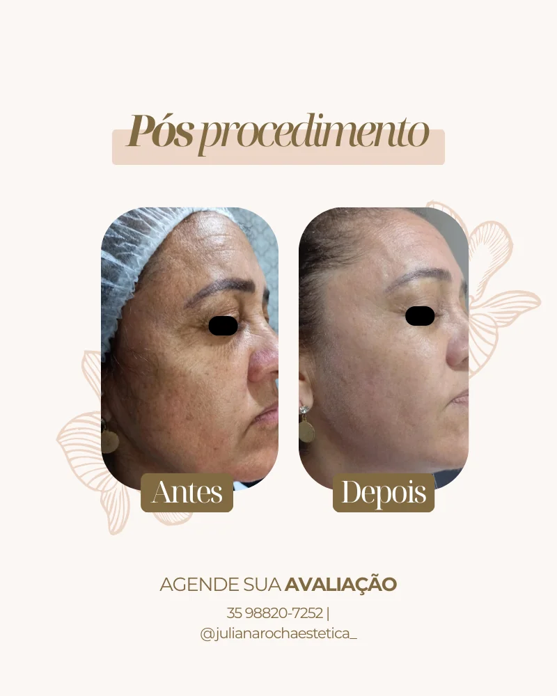 Resultado real — Microagulhamento em Varginha MG