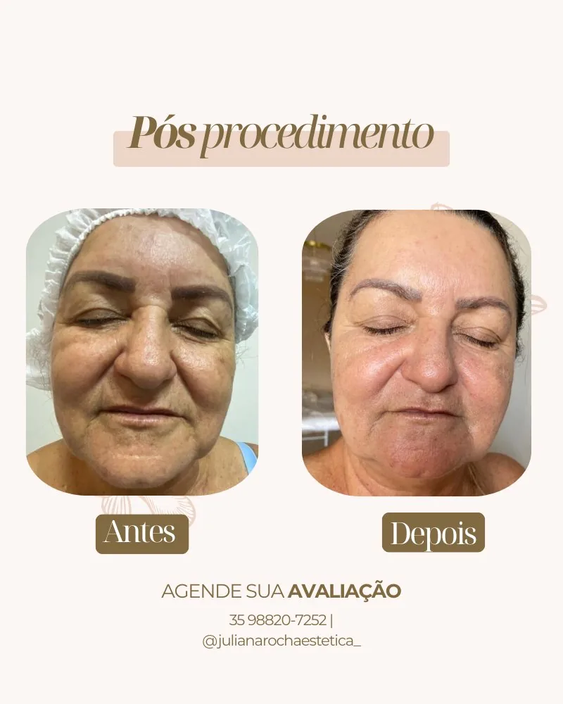 Resultado microagulhamento renovação pele luminosidade antes e depois Varginha MG