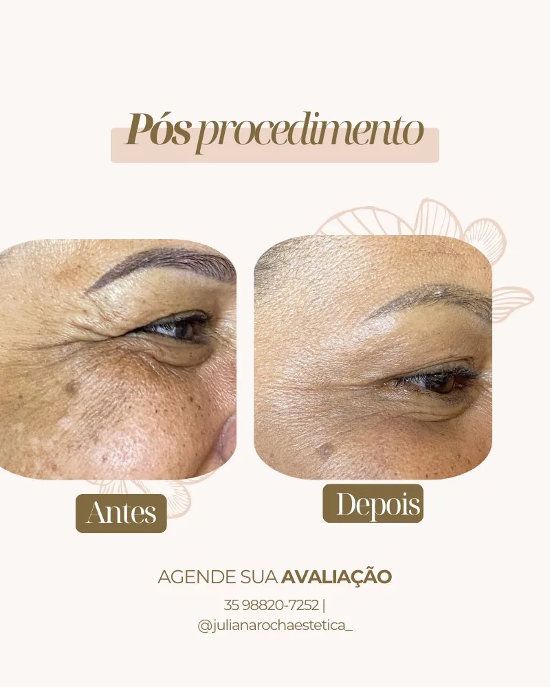 Resultado microagulhamento perfil antes e depois Varginha MG — pele renovada