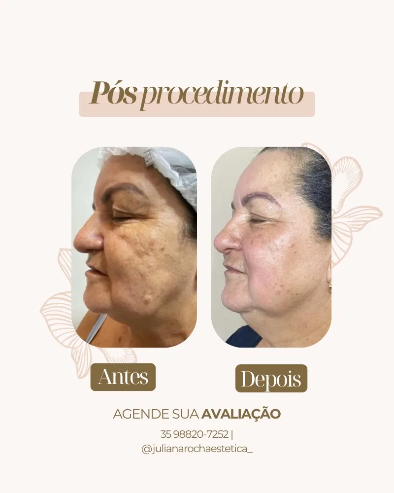 Resultado microagulhamento área periocular antes e depois Varginha MG — tratamento pele