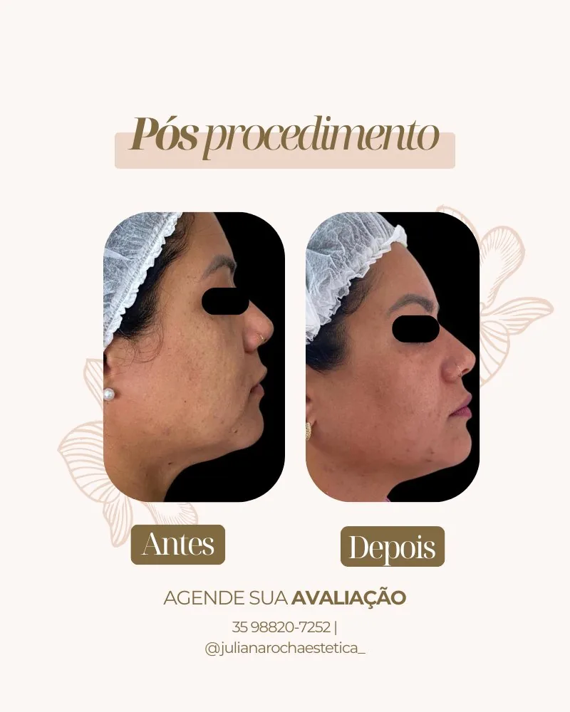 Resultado microagulhamento firmeza luminosidade antes e depois Varginha MG