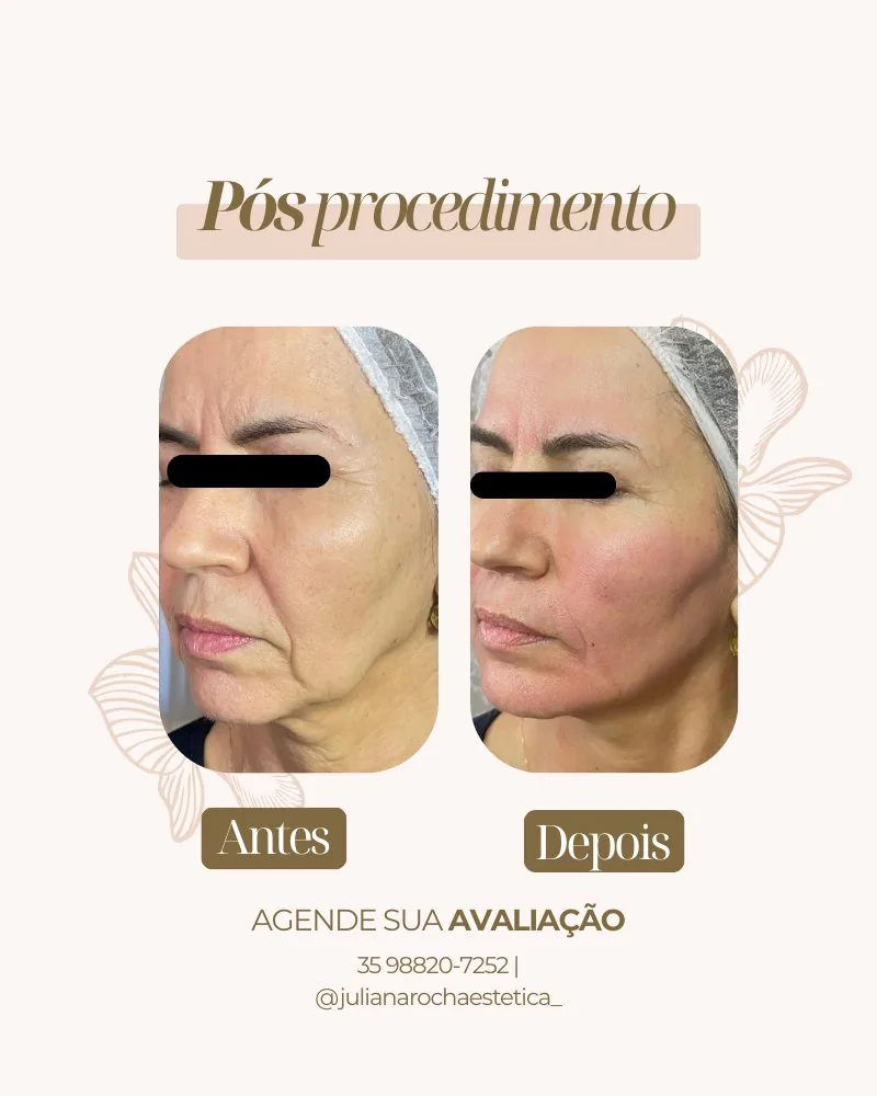 Resultado microagulhamento antes e depois Varginha MG — melhora de manchas e pele