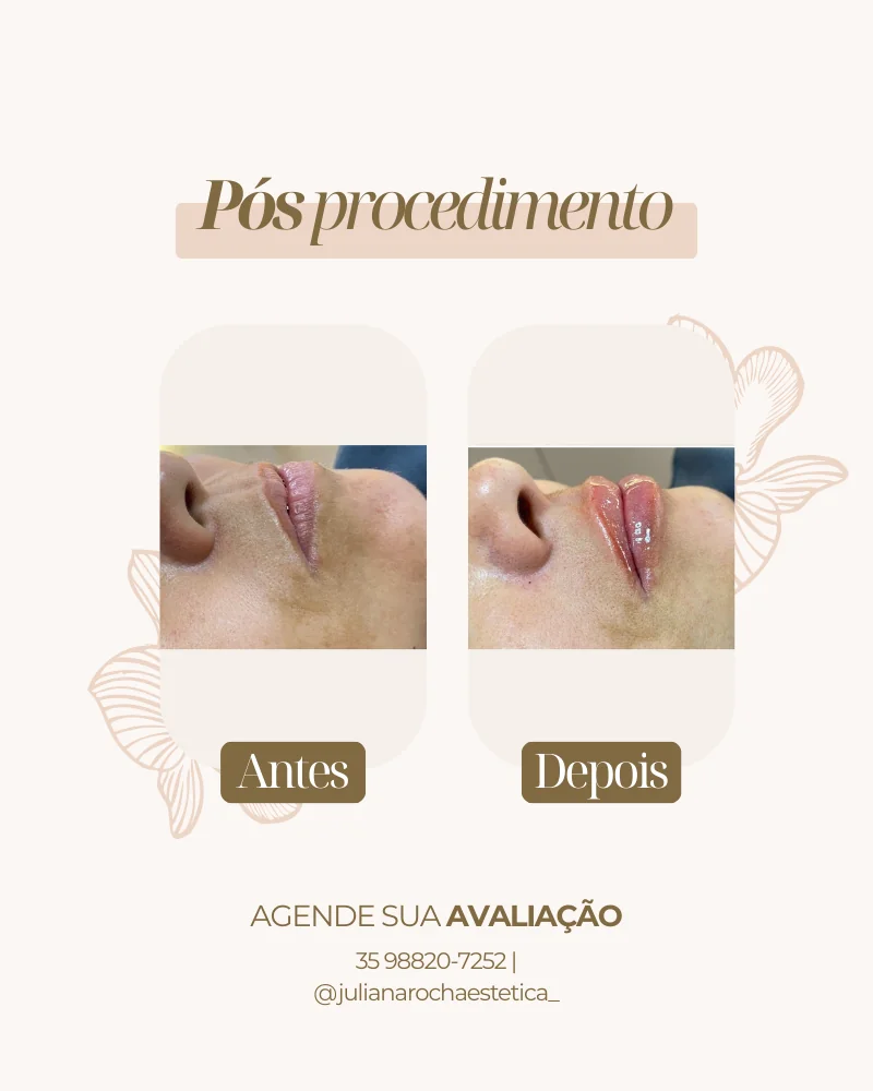 Resultado real — Preenchimento Labial em Varginha MG