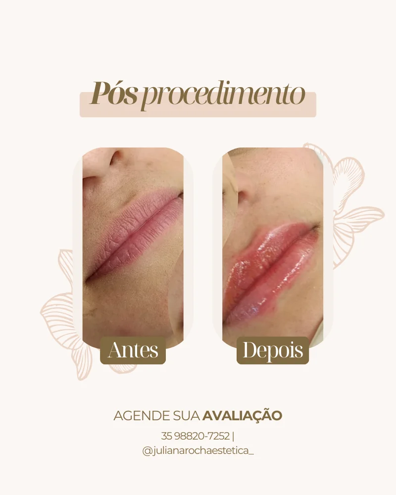 Resultado real — Preenchimento Labial em Varginha MG