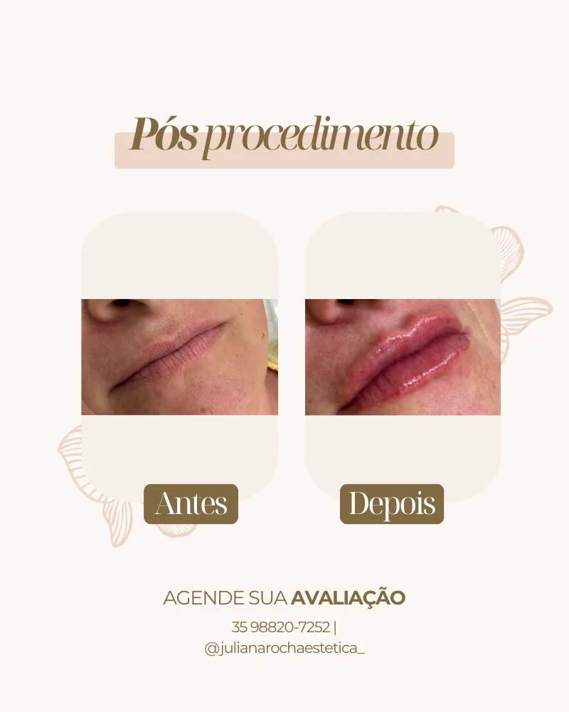 Resultado real — Preenchimento Labial em Varginha MG