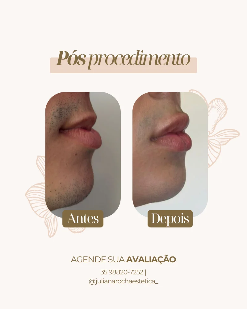 Resultado real — Preenchimento Labial em Varginha MG