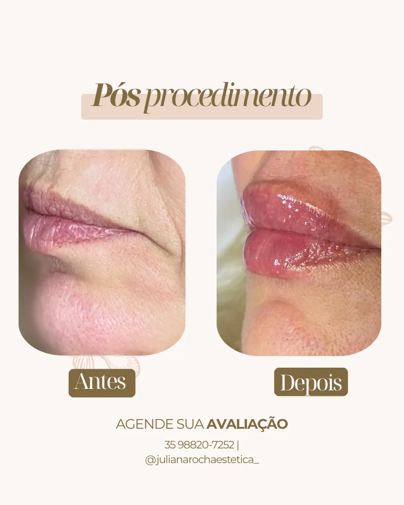 Preenchimento labial volume e definição antes e depois Varginha MG clínica Juliana Rocha