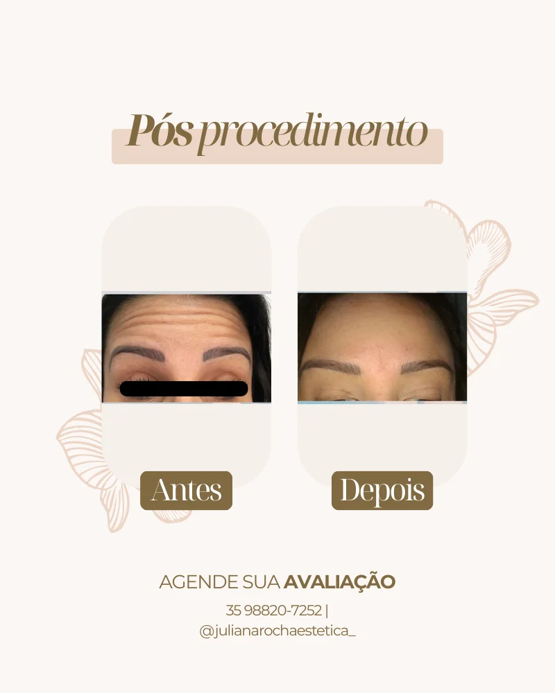 Resultado toxina botulínica botox antes e depois Varginha MG — rugas de expressão