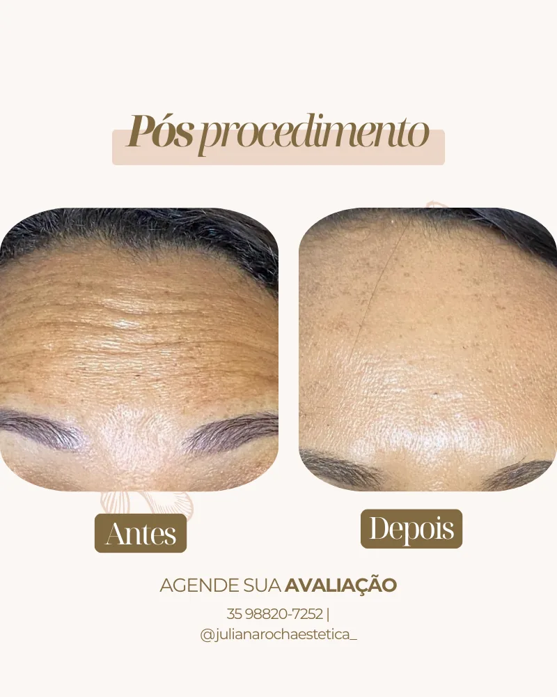 Toxina botulínica botox testa rugas expressão antes e depois Varginha MG